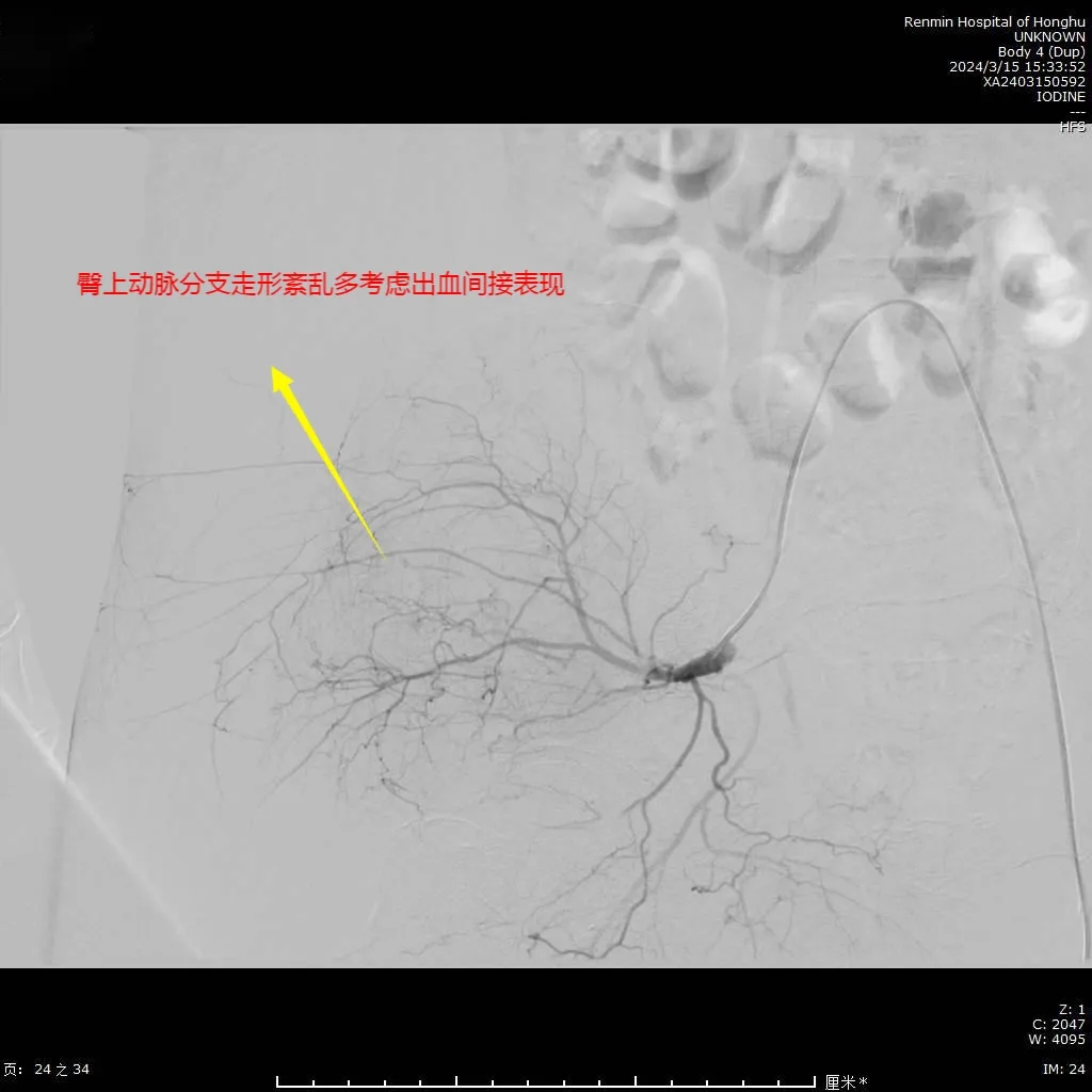 【救治“医”线 为生命奔跑】市人民医院成功救治一例骨盆骨折并创伤性休克患者